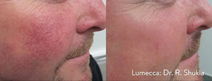 Lumecca_I_Before_and_After_2.jpg