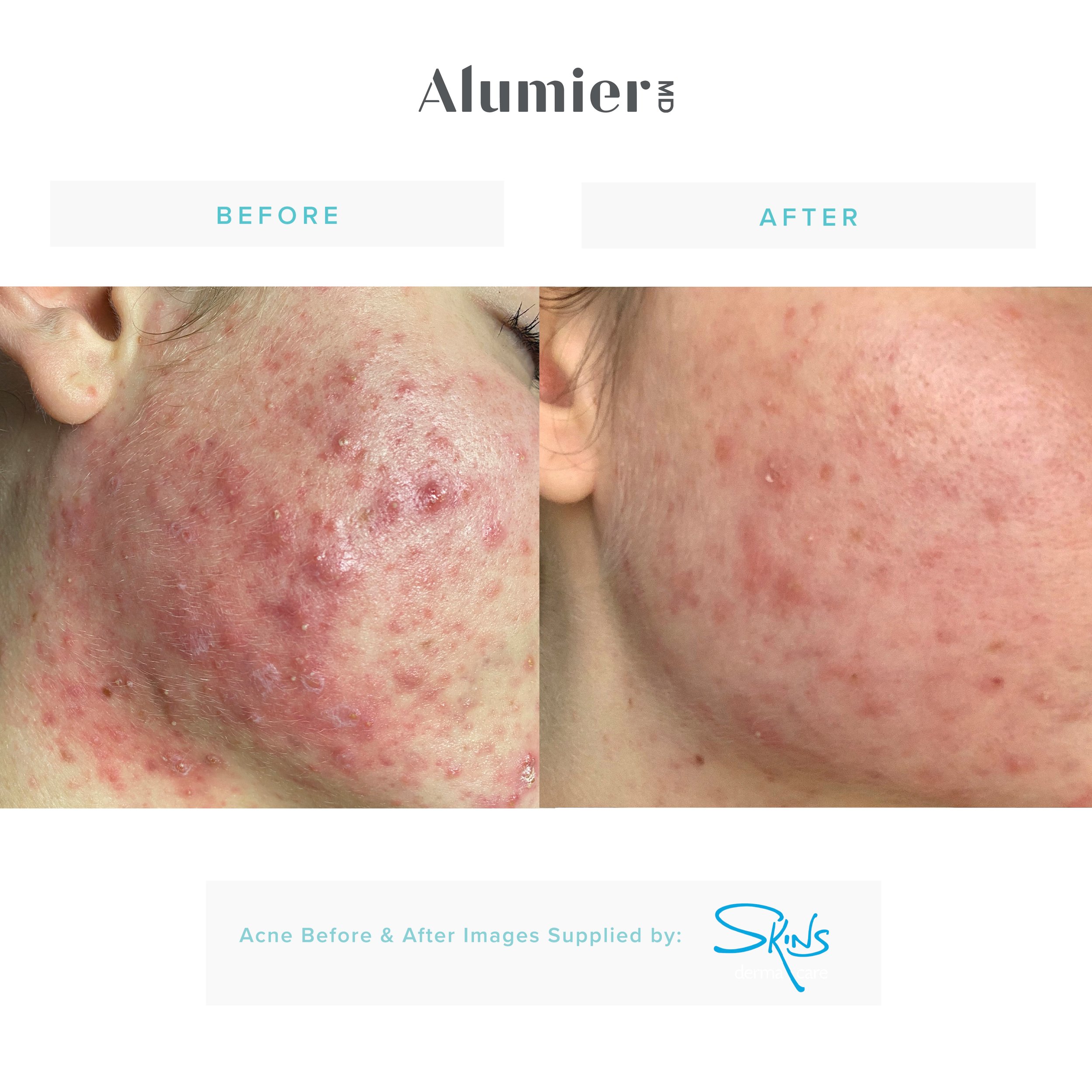 Before-& After_Blemish Prone Skin_SkinsDermaCare.jpg