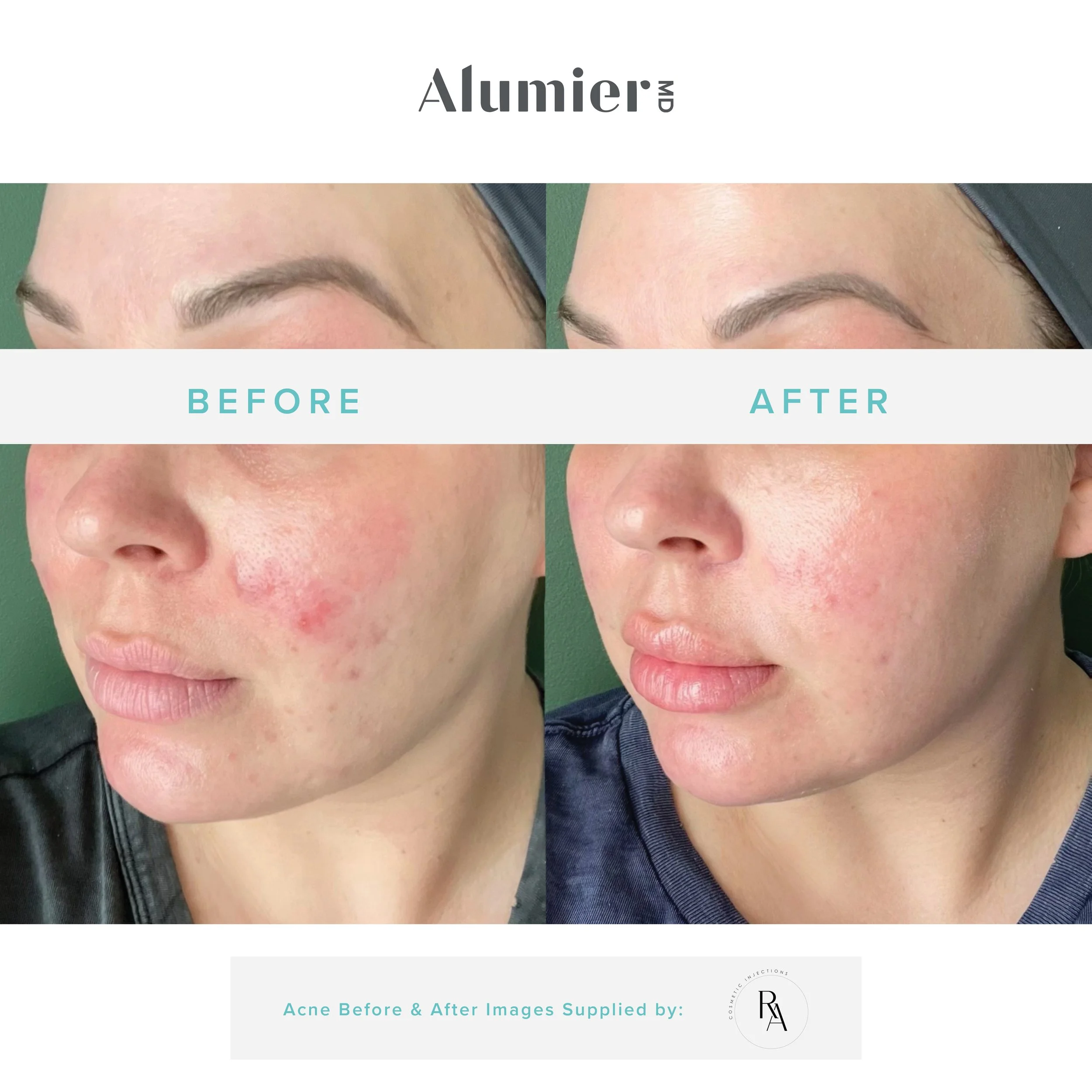 Before-& After_Blemish Prone Skin_ReviveAesthetics .jpg
