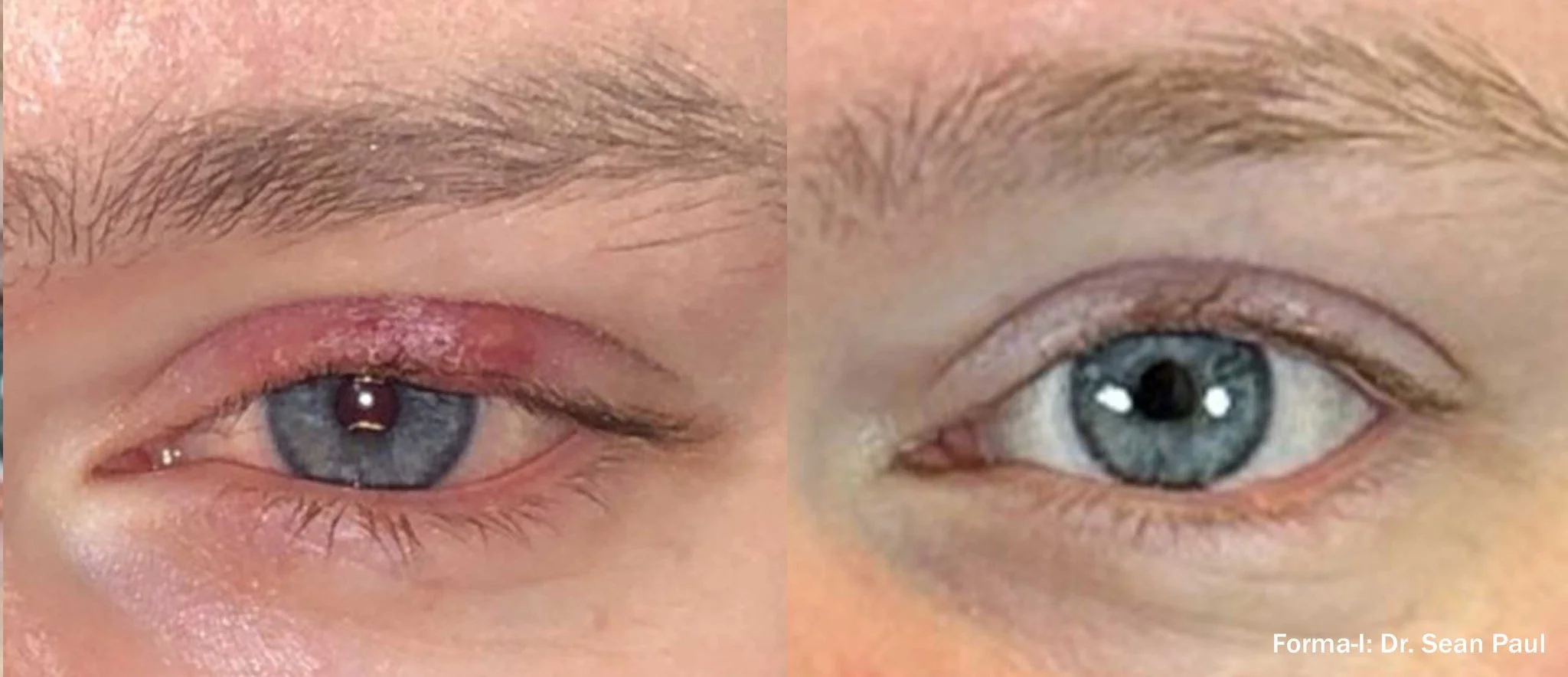 SP_Forma_I_Before_After_1_TM.jpg