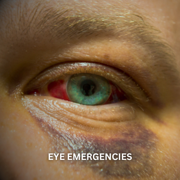 Close-up of a person's eye with redness and swelling, indicating an eye emergency. A black eye.