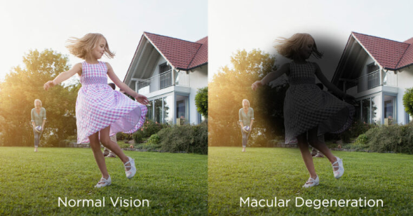 Side-by-side comparison of a girl jumping on a lawn, with a house and another girl in the background, showing normal vision and macular degeneration views.