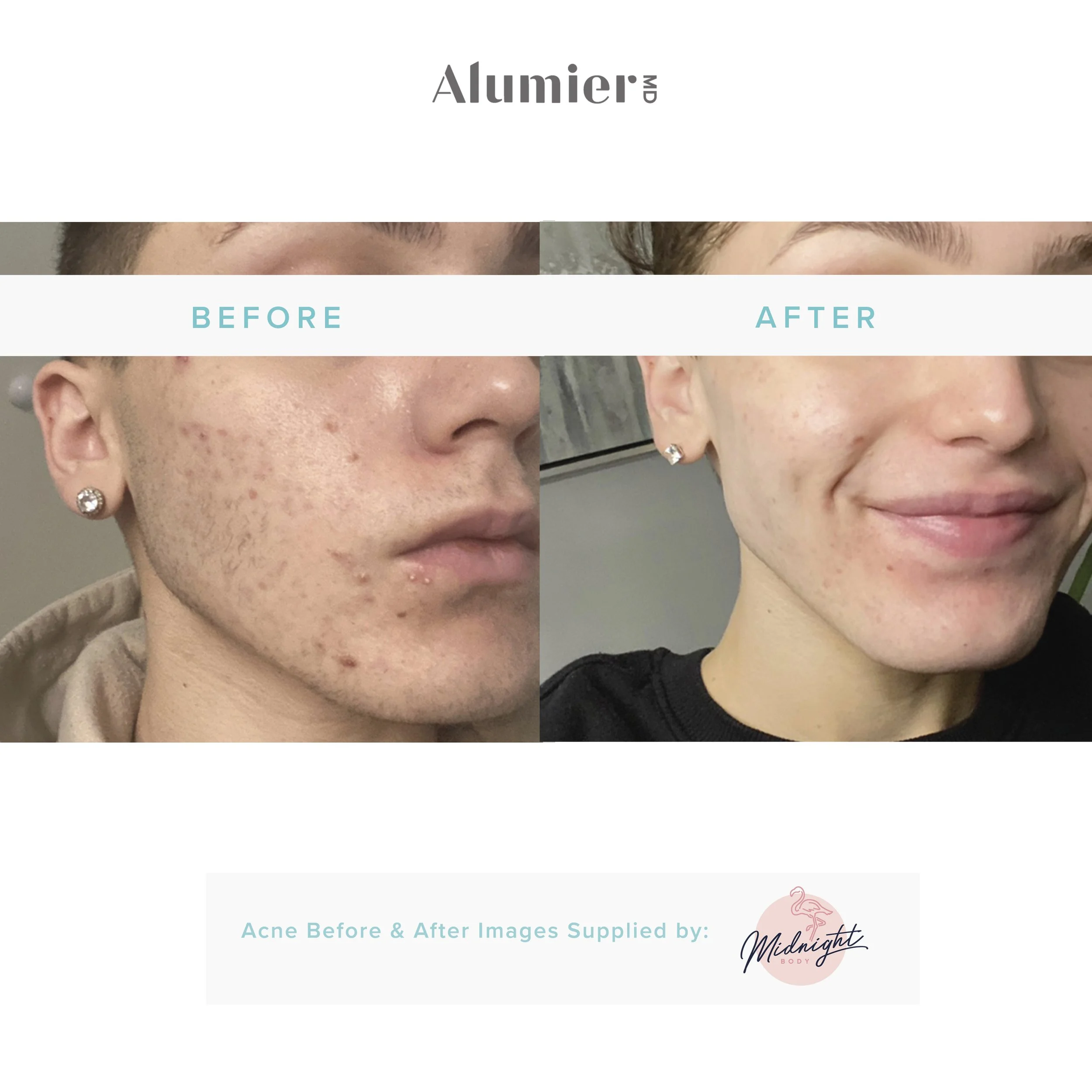 Before-& After_Blemish Prone Skin_MidnightBody.jpg