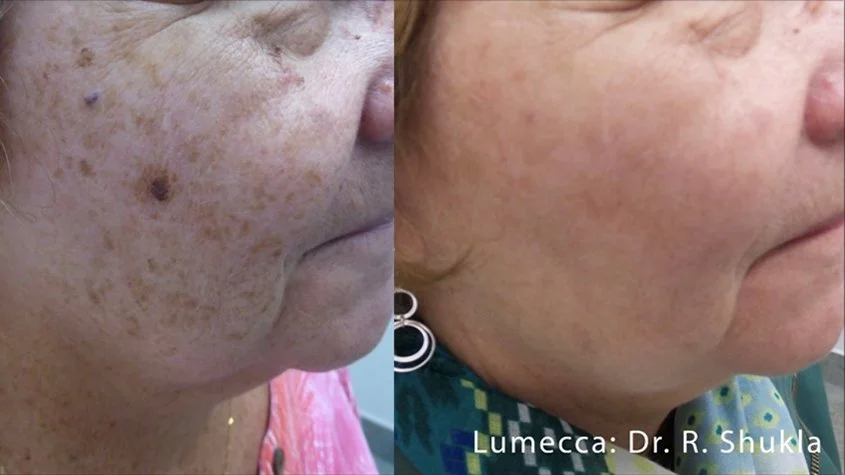 Lumecca_I_Before_and_After_3.jpg