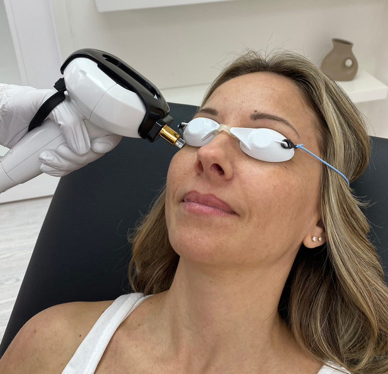 A woman receiving a dry eye treatment using Intense Pulsed Light (IPL) applied to her outer eye, with a technician performing the procedure in a clinical setting.