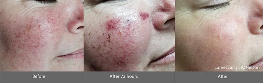 Lumecca_I_Before_and_After_4.jpg
