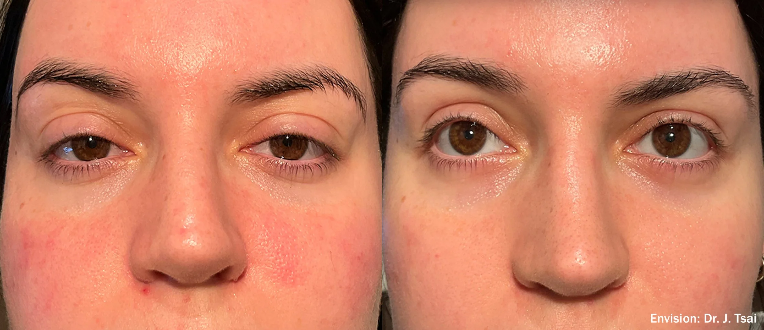 Envision_Lumecca & Forma_Cheeks_Before & After.jpg