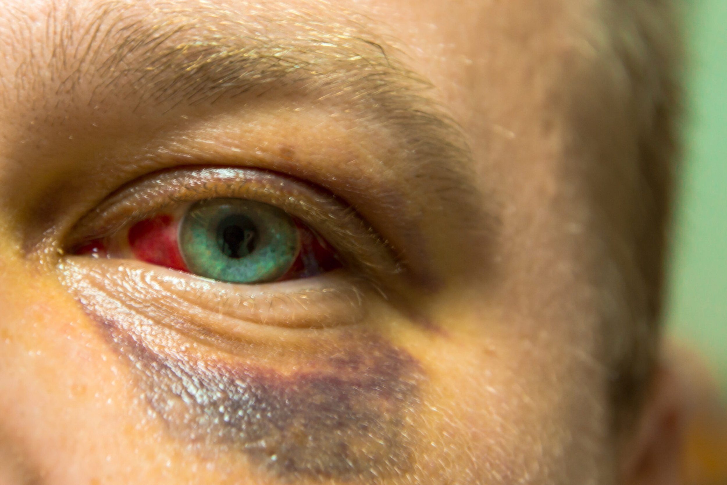Close-up of a person's face showing a single eye with green and brown coloring, brown skin tone, and textured skin