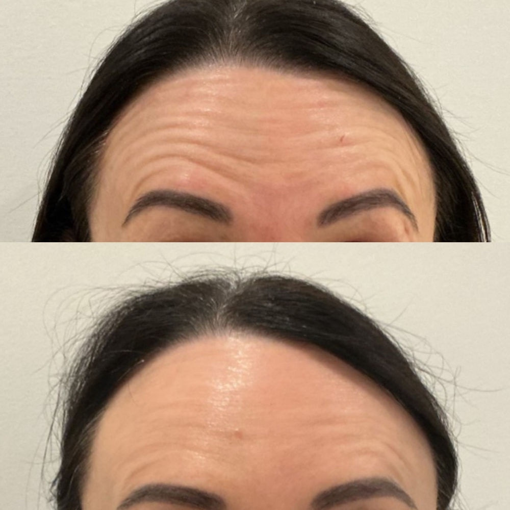 Forehead Anti-Wrinkle