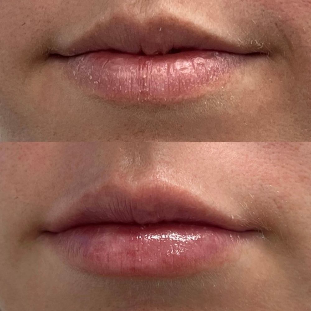 Lip Filler - 'M' Shaped lips