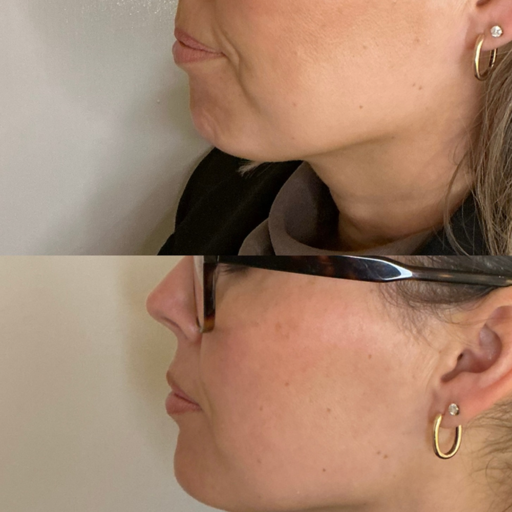 Chin Filler