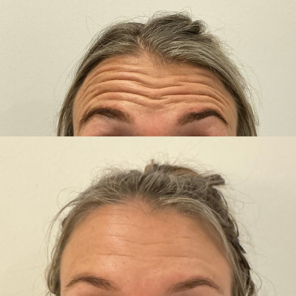 Forehead Anti-Wrinkle