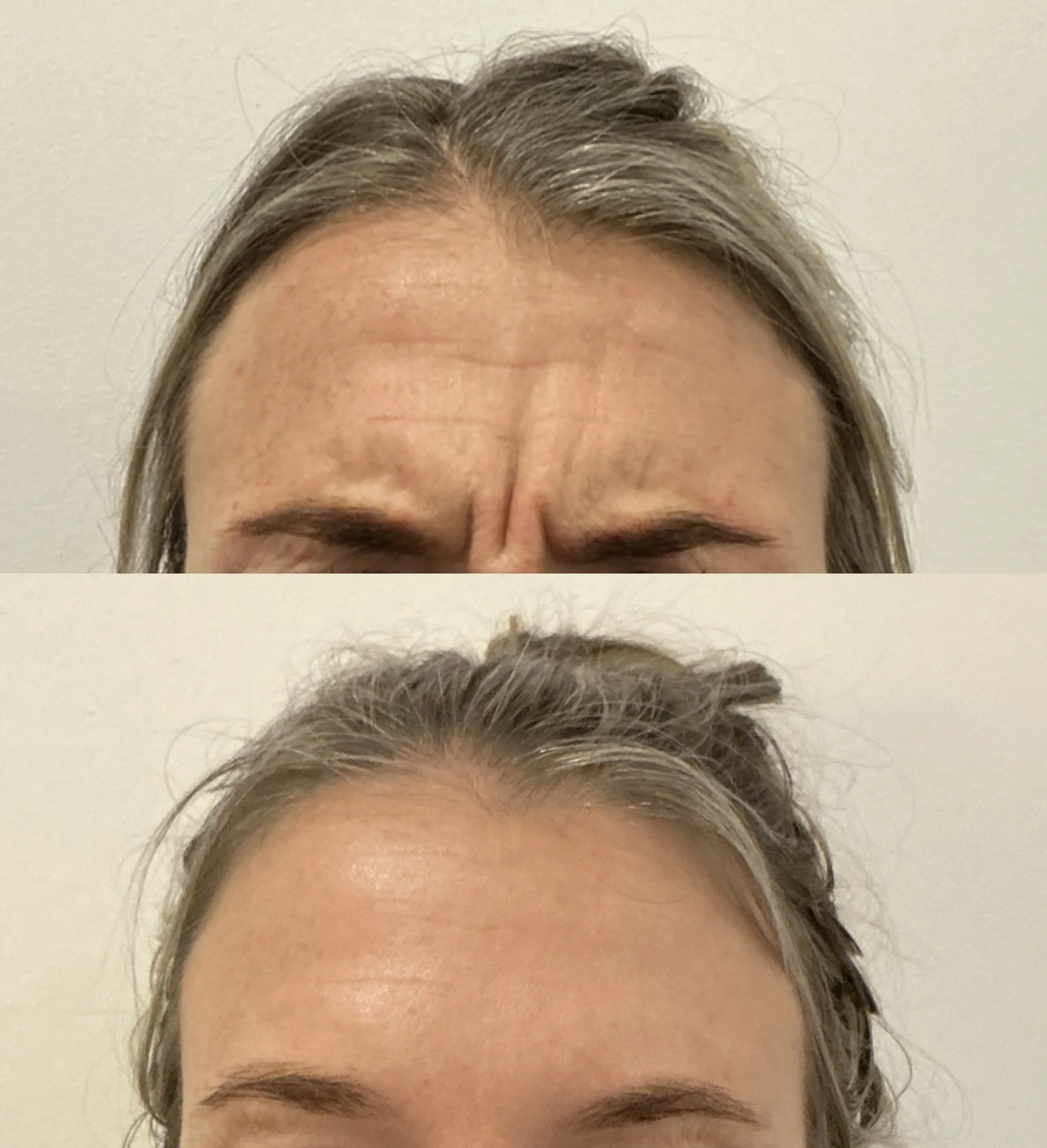 Frown Anti-Wrinkle