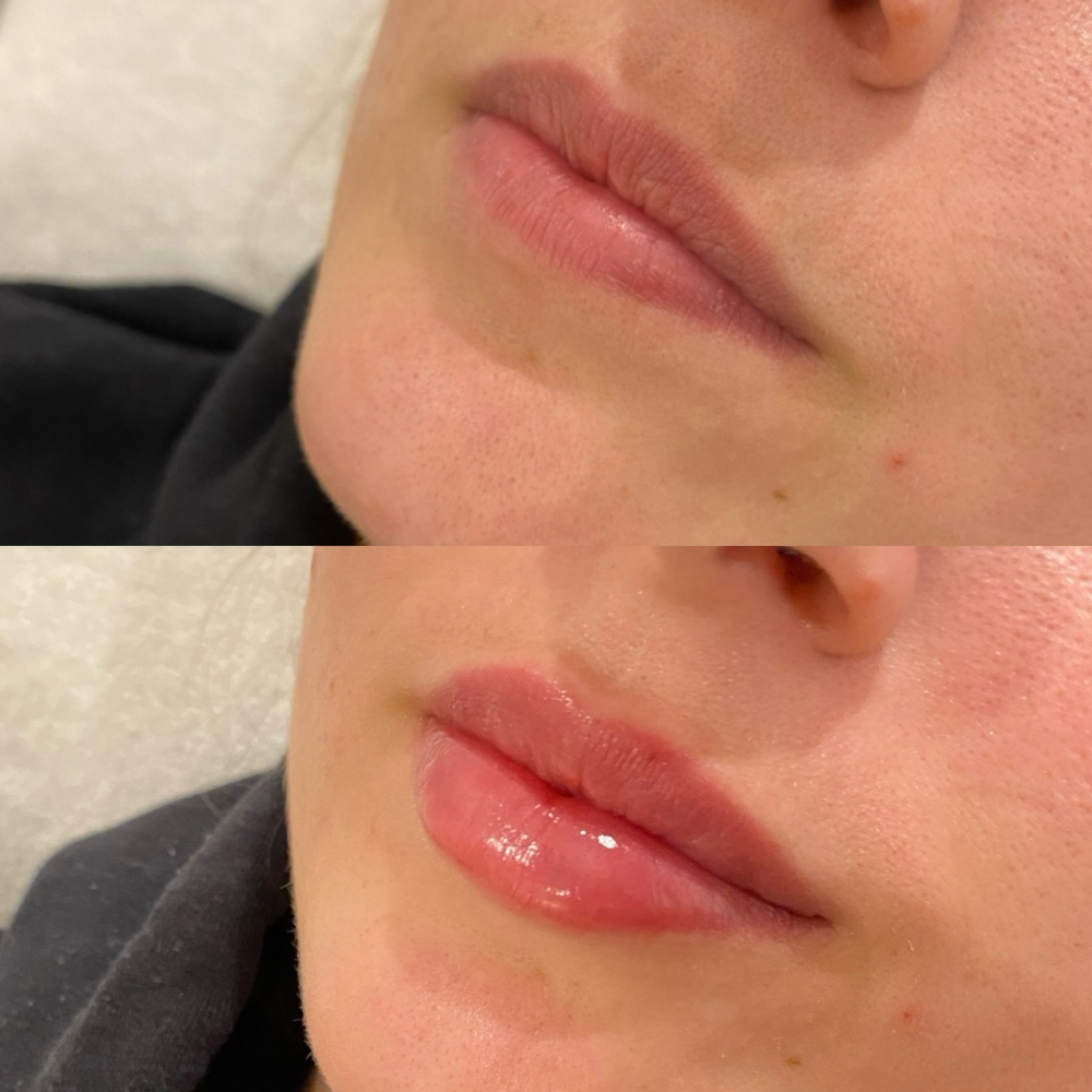 Lip Filler