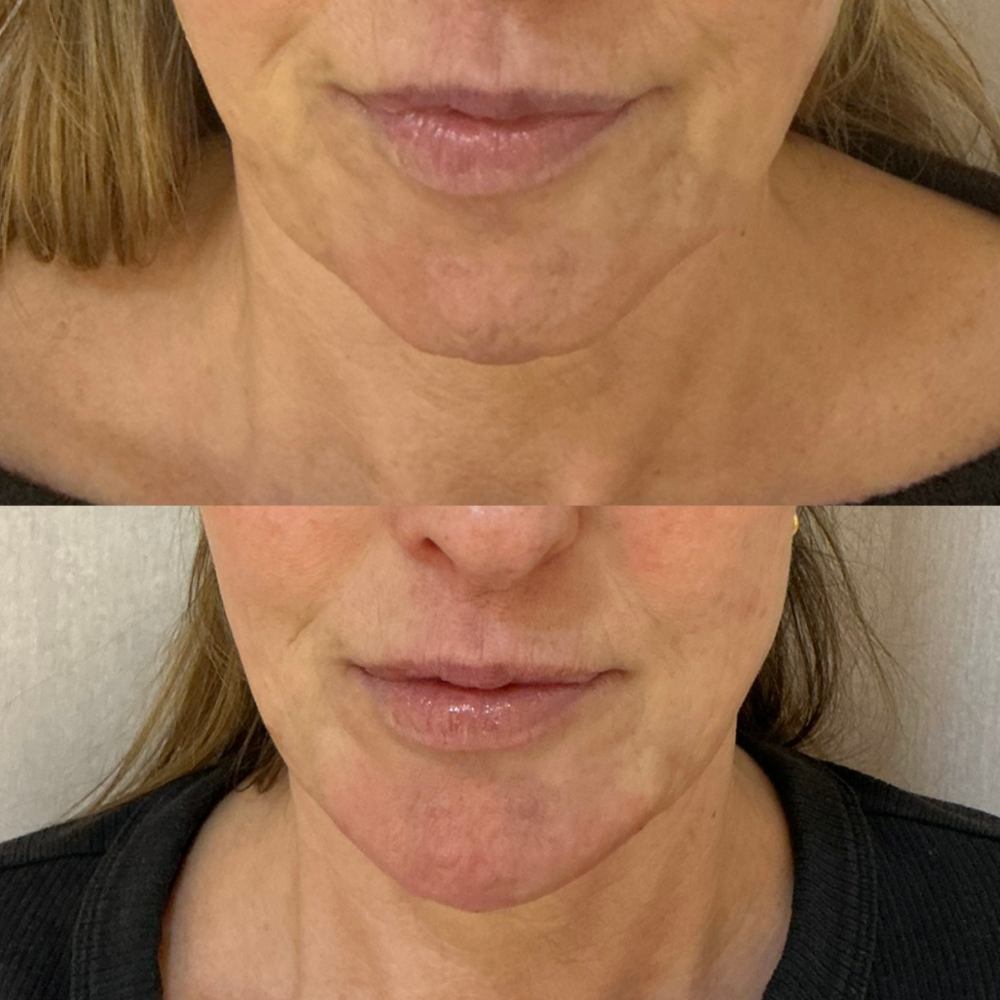 Chin and Jowl Filler