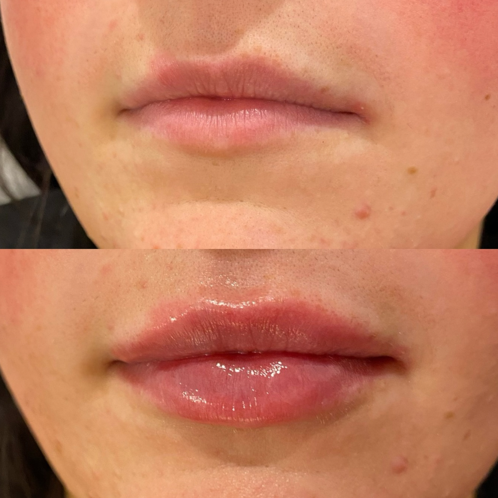 Lip Filler