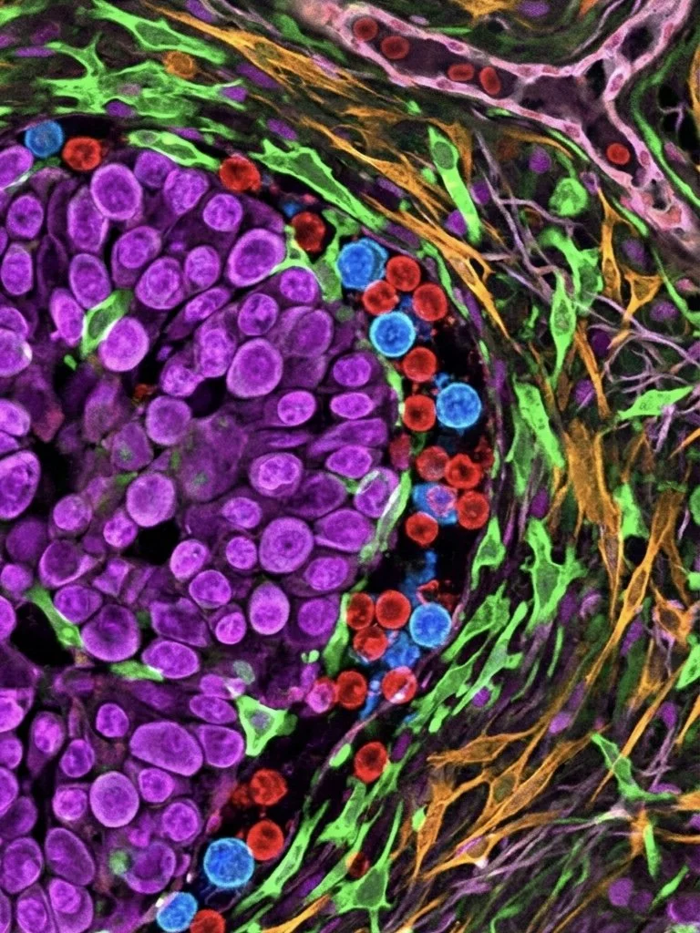 Could a blood test reveal the tumour microenvironment? What new research means for lung cancer