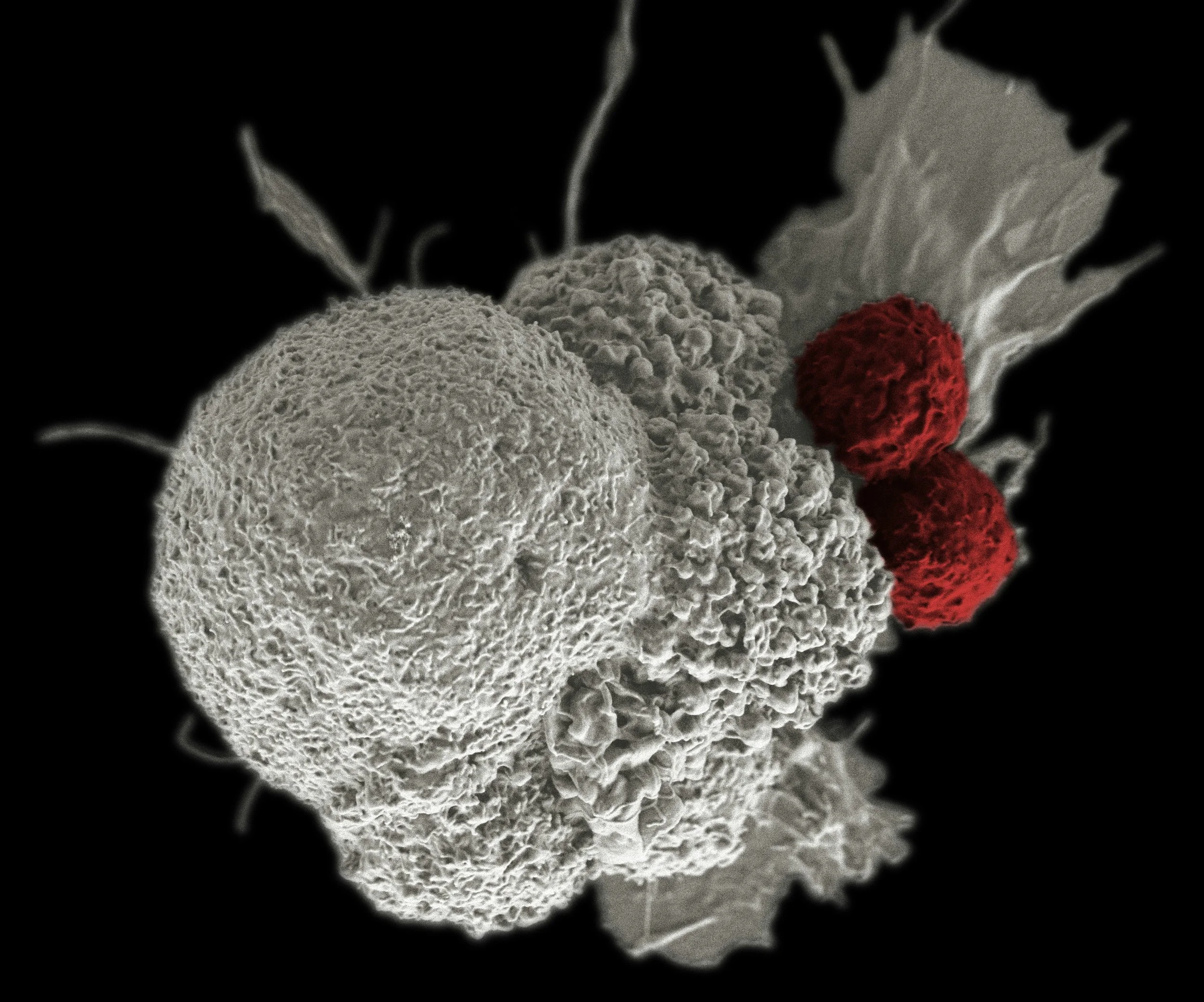 What Could a New Iron Discovery Mean for Lung Cancer Immunotherapy?