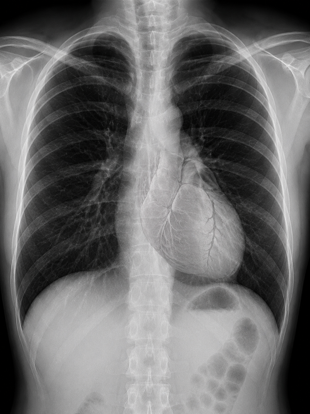 Lung cancer and heart health: understanding the two-way connection