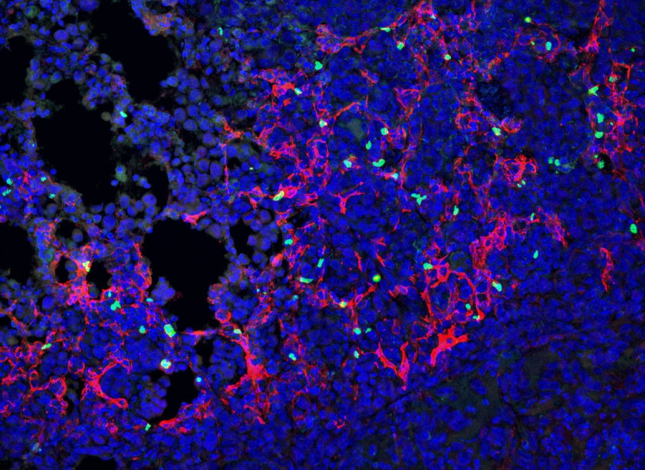 PhD research uncovers new cell population that may help lung cancer suppress the immune system