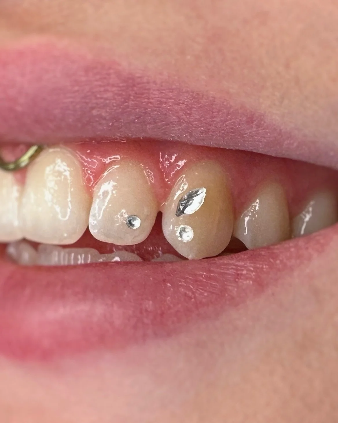 Half butterfly and a little accent gem 💕

Done during my guest spot at @le.116.tattooclub 

Merci 🖤

Tooth gems, bijoux dentaires, butterfly, Swarovski, Montr&eacute;al, Sherbrooke