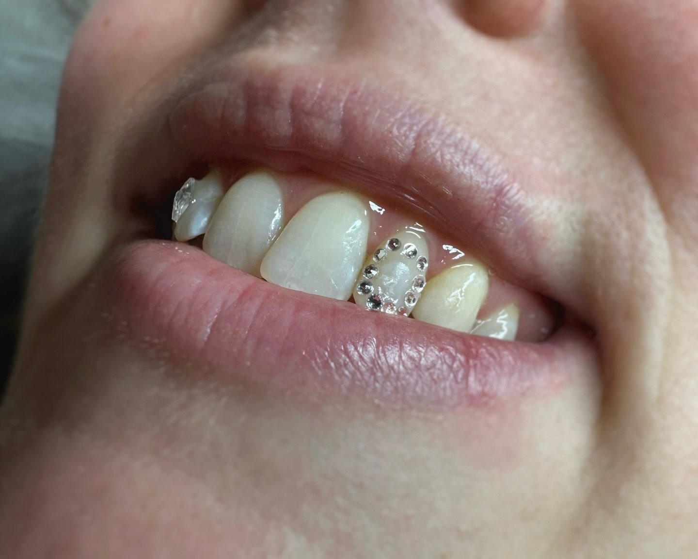 Window tooth gems and diamond on @brue_la &lsquo;s incisors

Loved doing this set, and loved meeting you! 

Merci Sarah! 

Tooth gems, Swarovski, bijoux dentaires, strass dentaire, Montreal