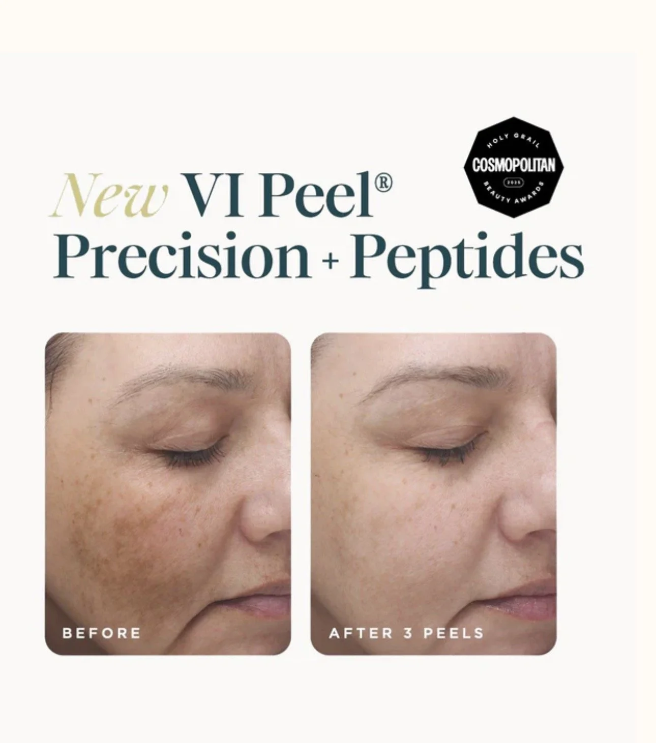 Before and after images showing skin improvement from a new VI Peel. The skin appears clearer and smoother after three peels.