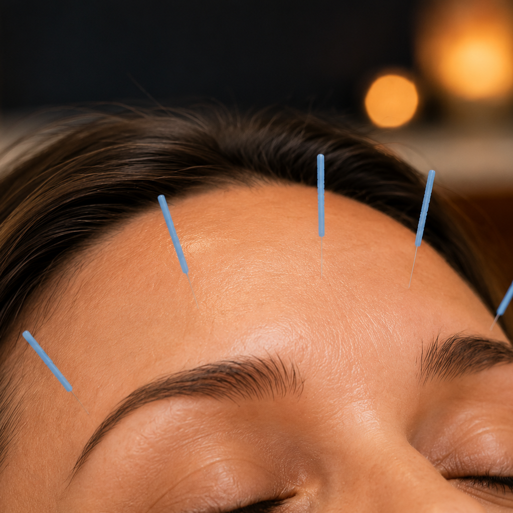 Close-up of a person's forehead with acupuncture needles inserted along the hairline.