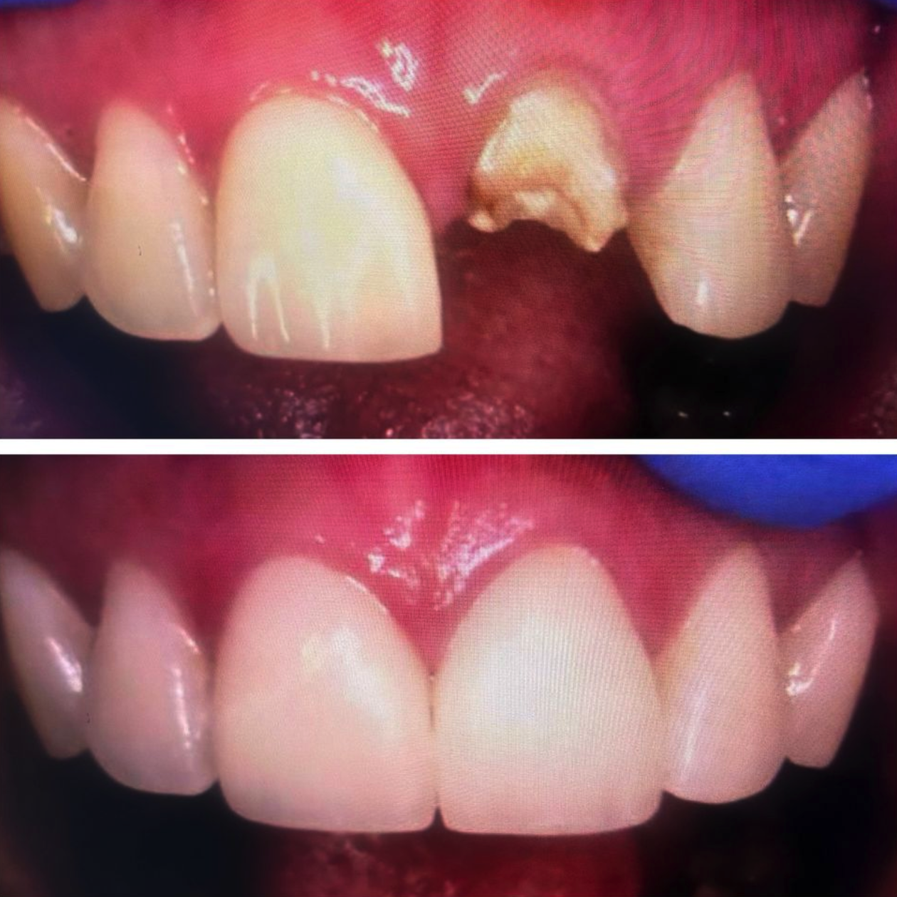 In-Office Teeth Whitening and Two Crowns