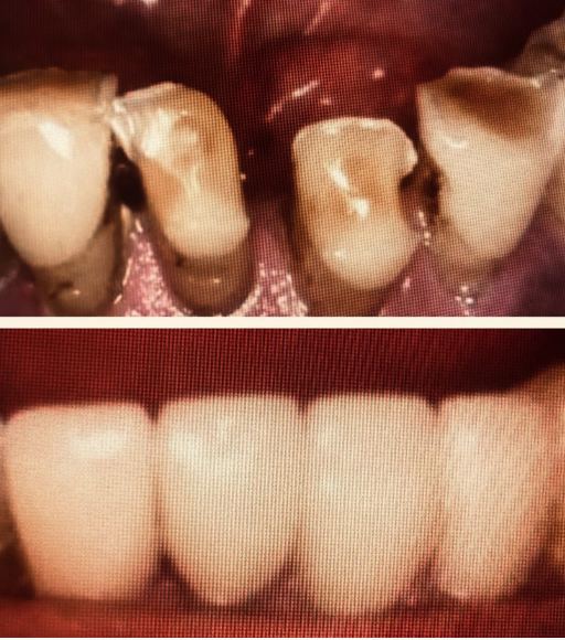 Full Porcelain Crowns