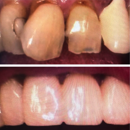 Full Porcelain Crowns