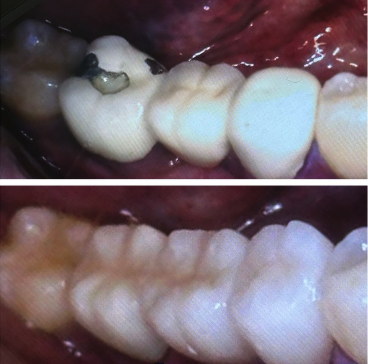 Metal Bridge Replaced with All Porcelain Bridge