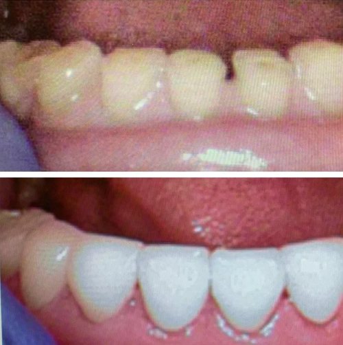 Lower Porcelain Crowns