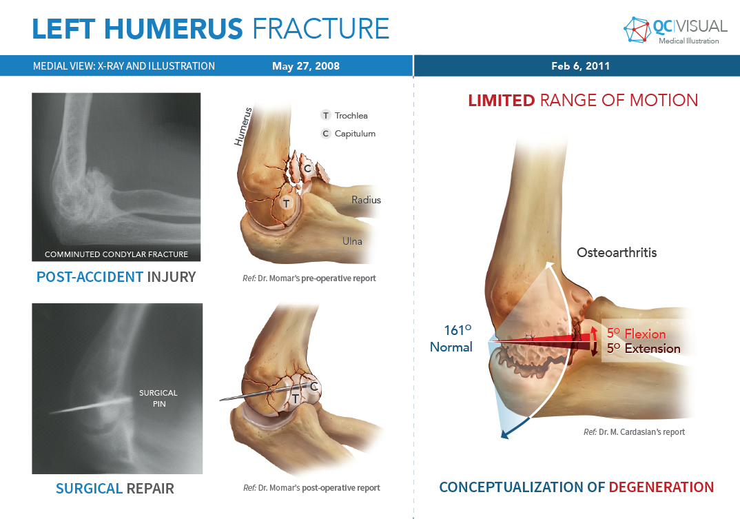Comparison of X-ray and medical illustrations of a left humerus fracture, showing post-accident injury with comminuted condylar fracture and surgical repair with pin, along with diagrams of partial range of motion limitations and degeneration due to 