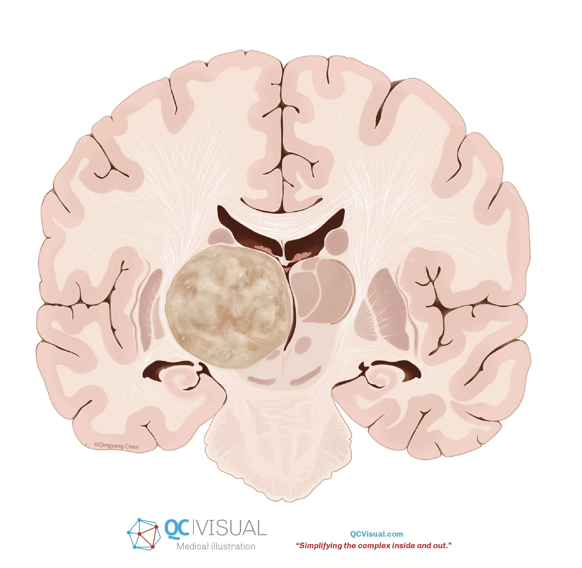 Illustration of a human brain with a lunar surface replica in the left hemisphere.