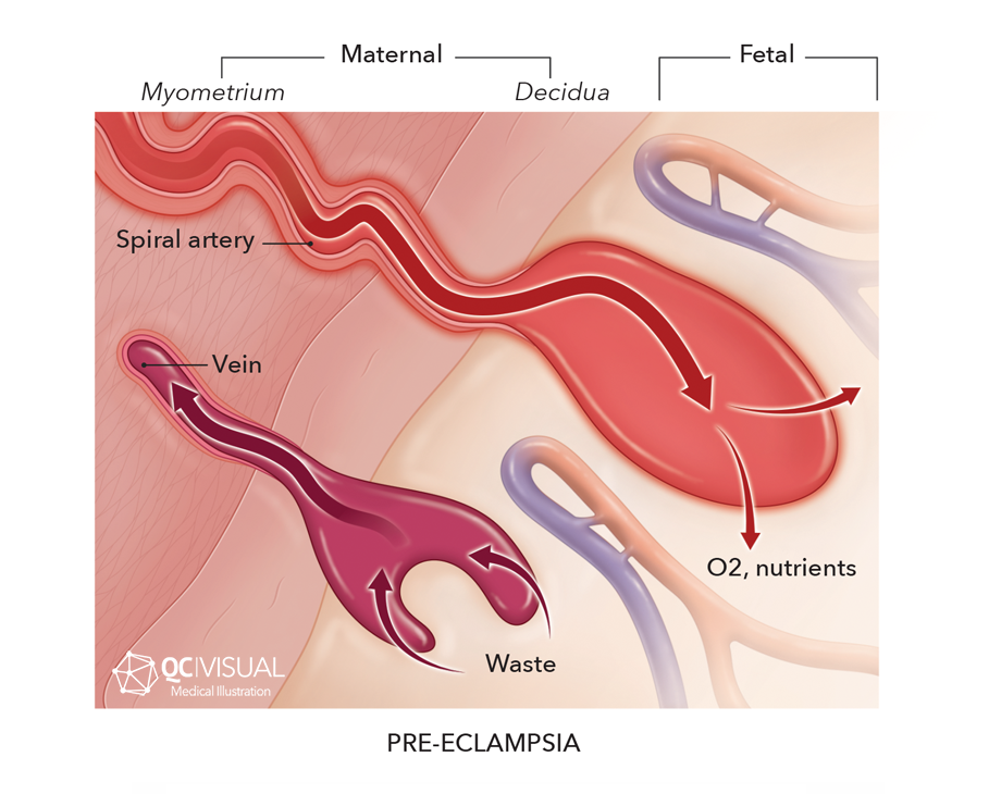 Diagram illustrating pre-eclampsia, showing maternal and fetal blood vessels, with labels for spiral artery, vein, and areas of oxygen and nutrient exchange, highlighting abnormal blood flow in pre-eclampsia.