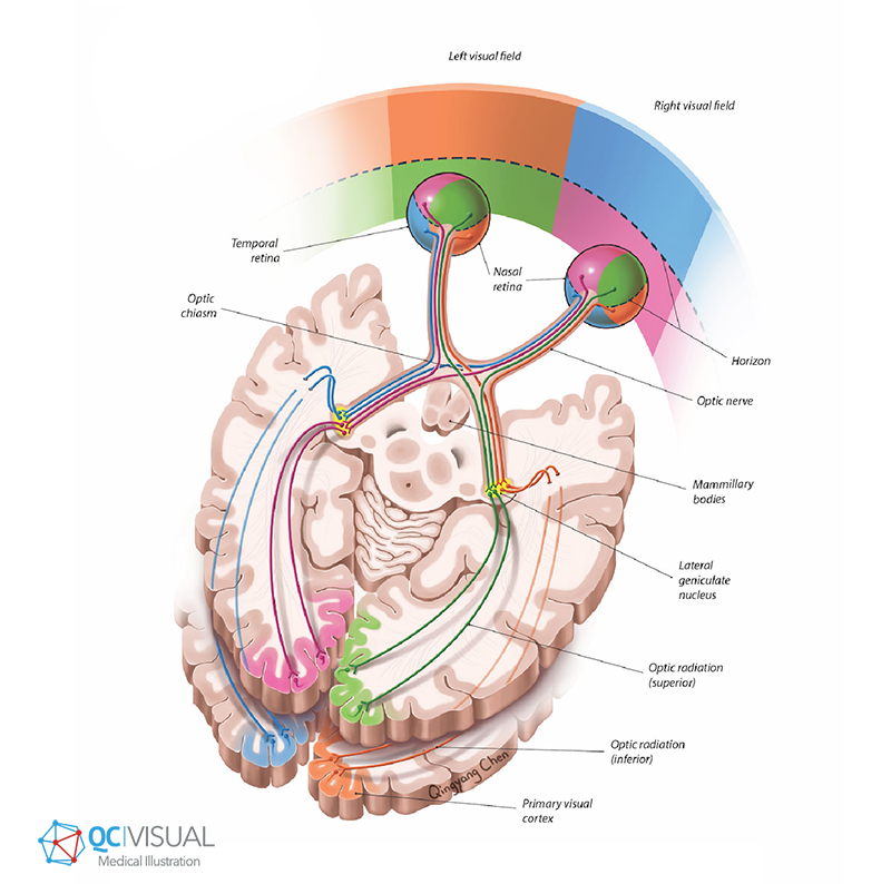Diagram of the visual pathway in the brain, illustrating the left and right visual fields, optic chiasm, optic nerves, optic radiations, lateral geniculate nucleus, primary visual cortex, and related structures.