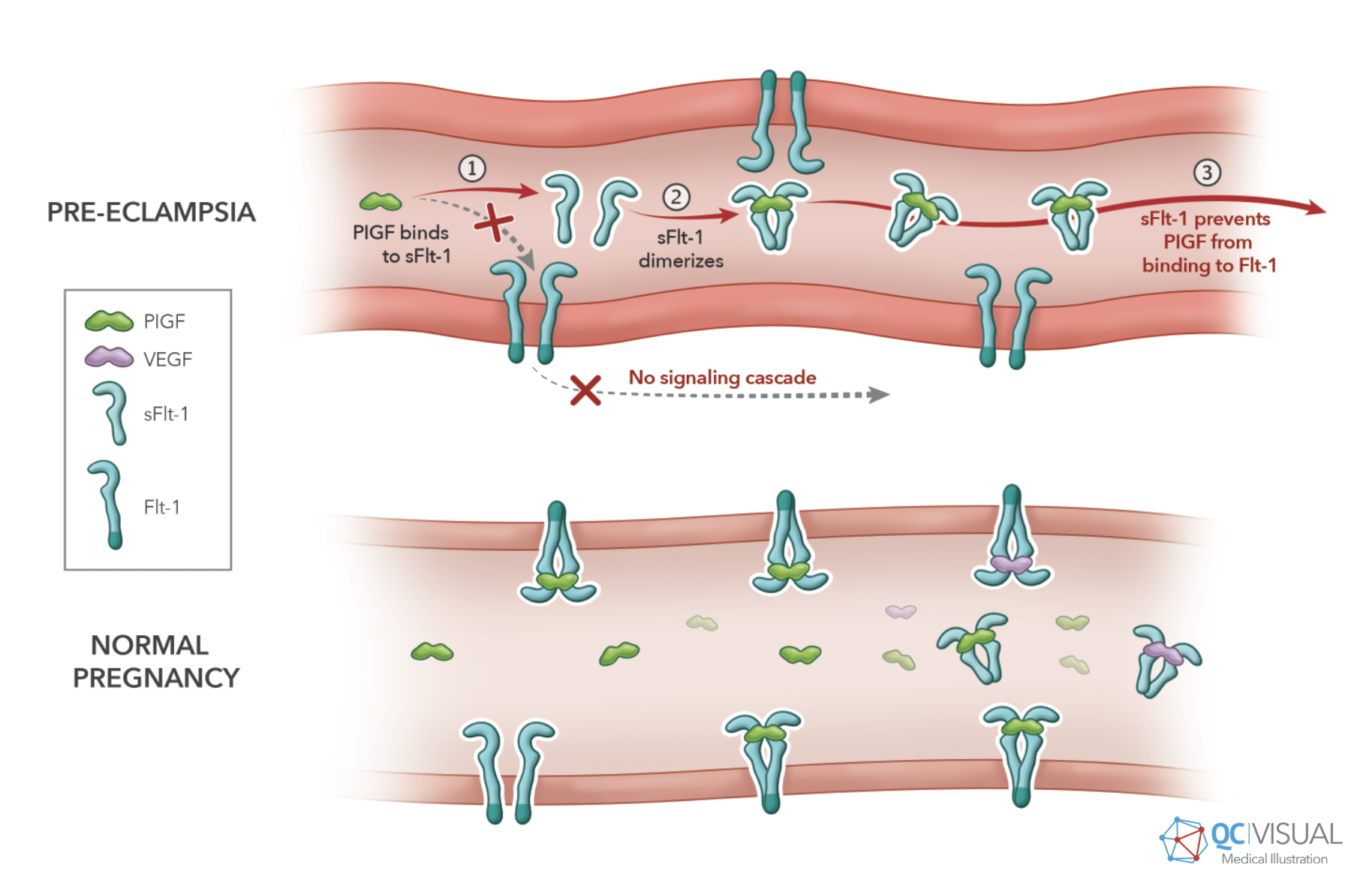 Diagram showing the molecular pathway of pre-eclampsia, with PIGF binding to sFlt-1 to prevent PIGF from binding to Flt-1, blocking signaling cascade in pre-eclampsia, versus normal pregnancy with multiple growth factor interactions.