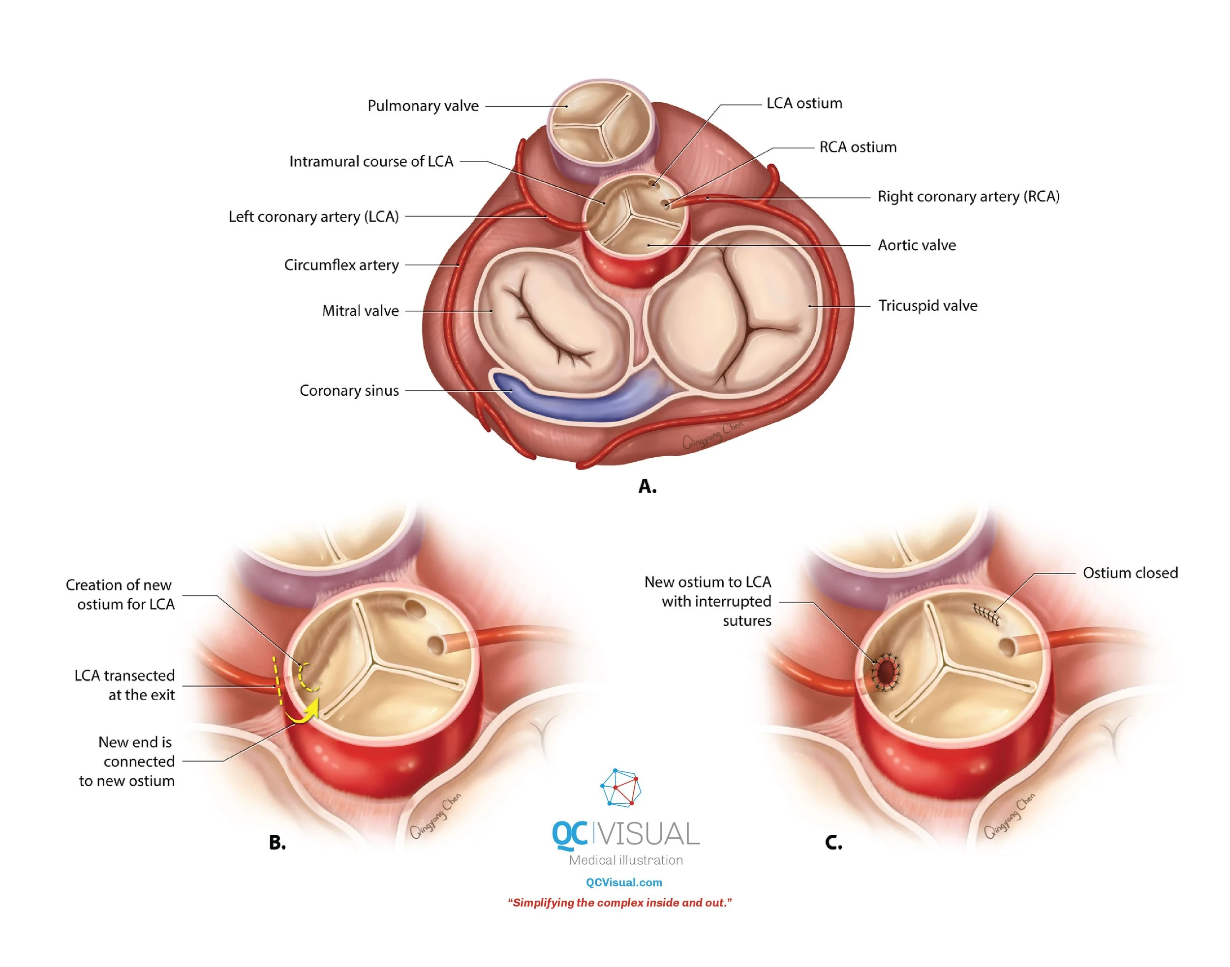Medical illustration of a heart cross-section with detailed labels, and diagrams showing the creation of a new ostium for the left coronary artery (LCA) using surgical sutures and reconnection procedures.