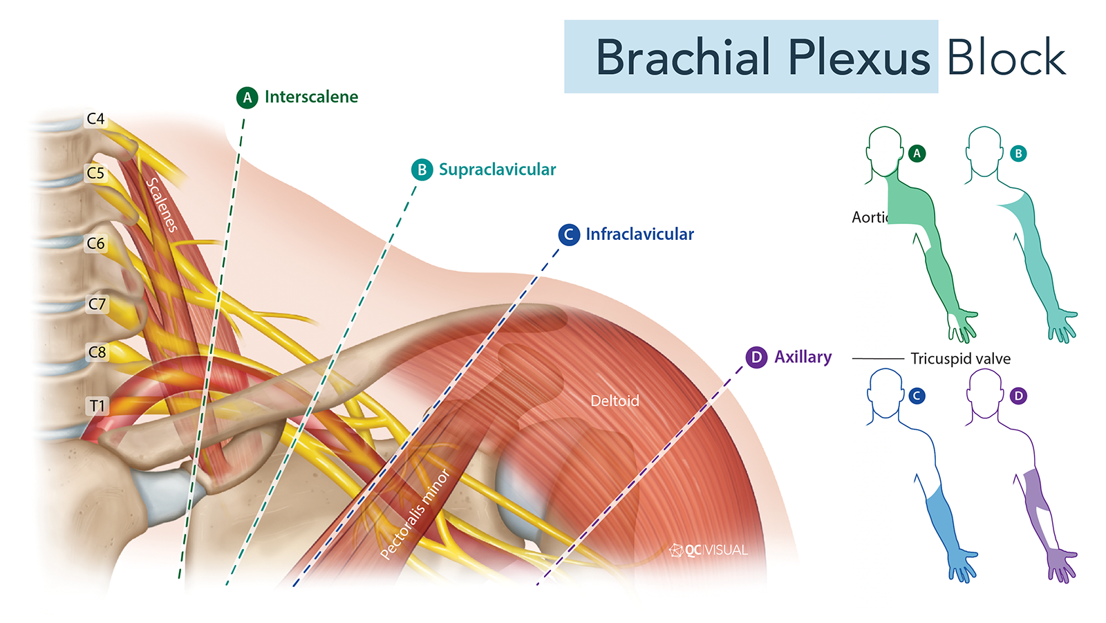 Diagram of the brachial plexus nerves highlighting different sections: Interscalene, Supraclavicular, Infraclavicular, and Axillary, with color-coded illustrations of the arm sections labeled A, B, C, and D.
