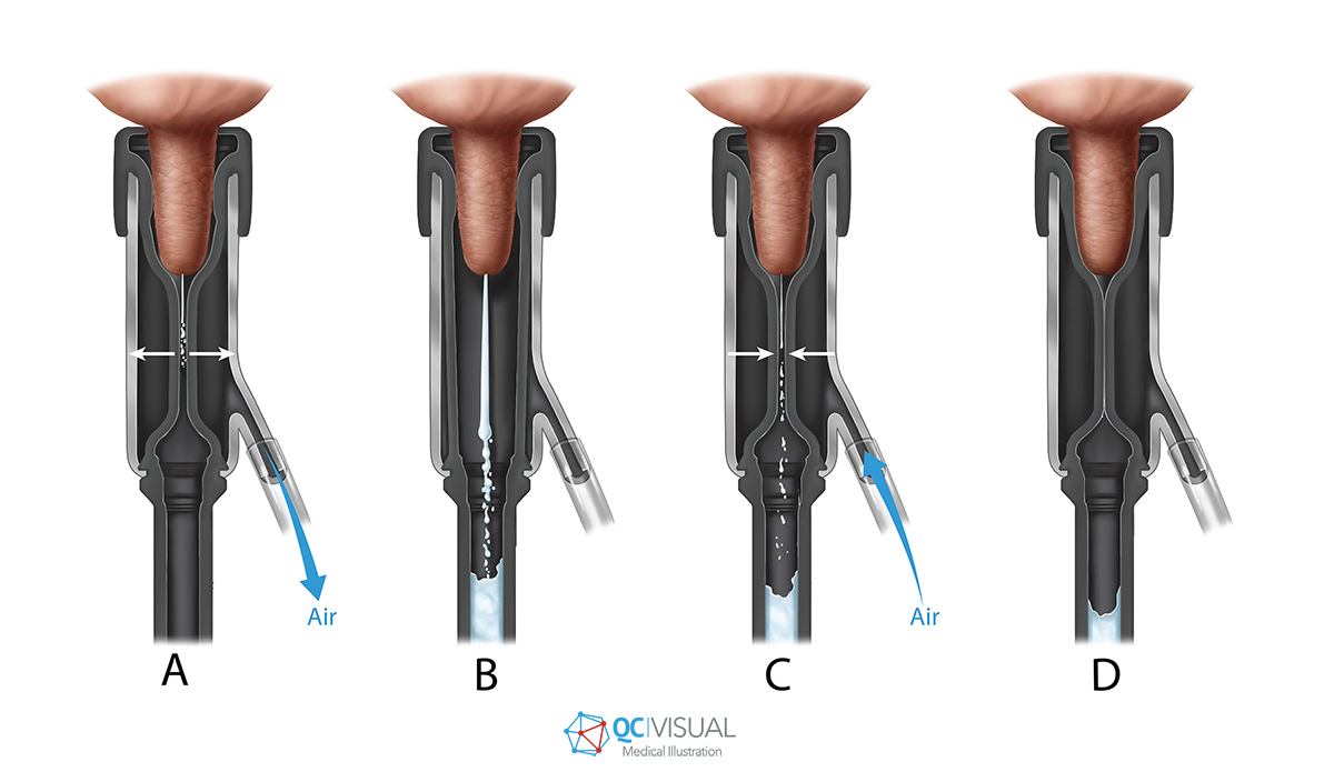 Medical illustration showing different stages of a procedure involving milking a cow's teat, with labels A through D indicating steps