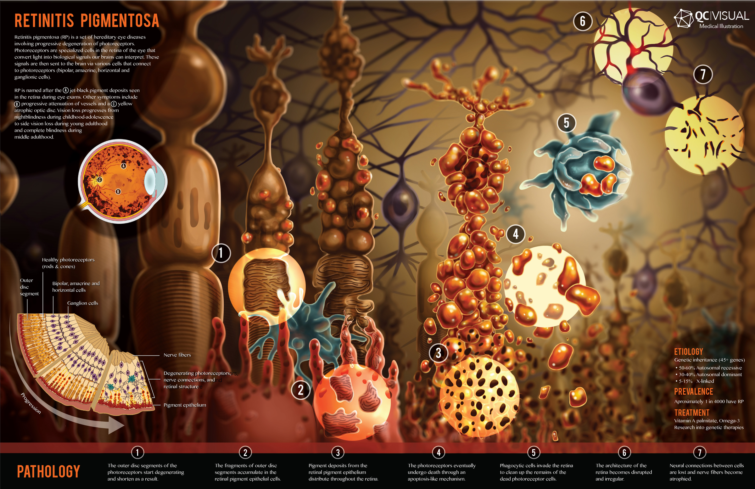 Diagram showing the process of retinitis pigmentosa affecting the retina, with numbered illustrations of retinal cells, photoreceptors, and nerve fibers, alongside text describing disease progression and pathology.