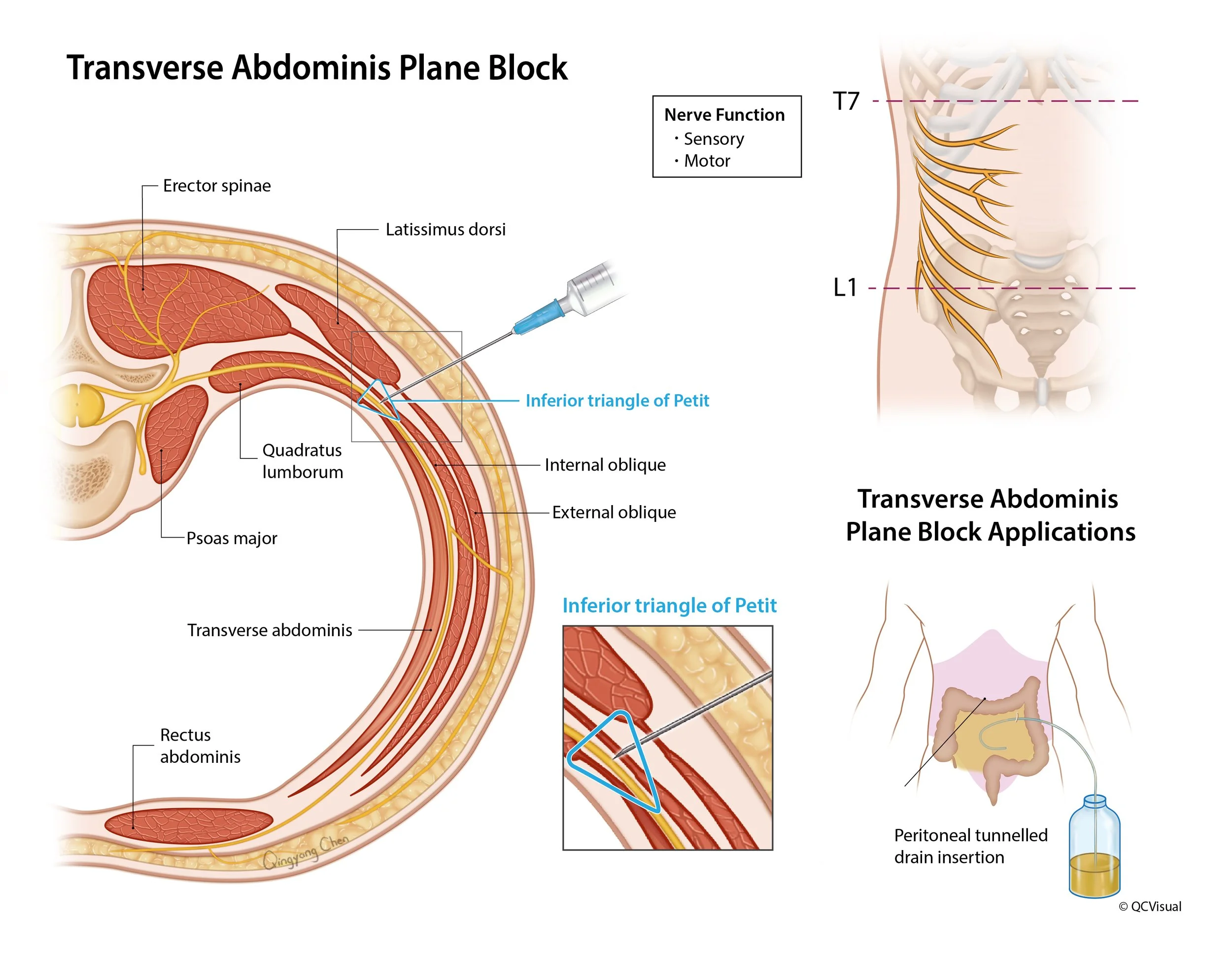 Diagram of a transversus abdominis plane block showing anatomy, nerve functions, and application techniques, including an injection site near the inferior triangle of Petit and an illustration of drain insertion.