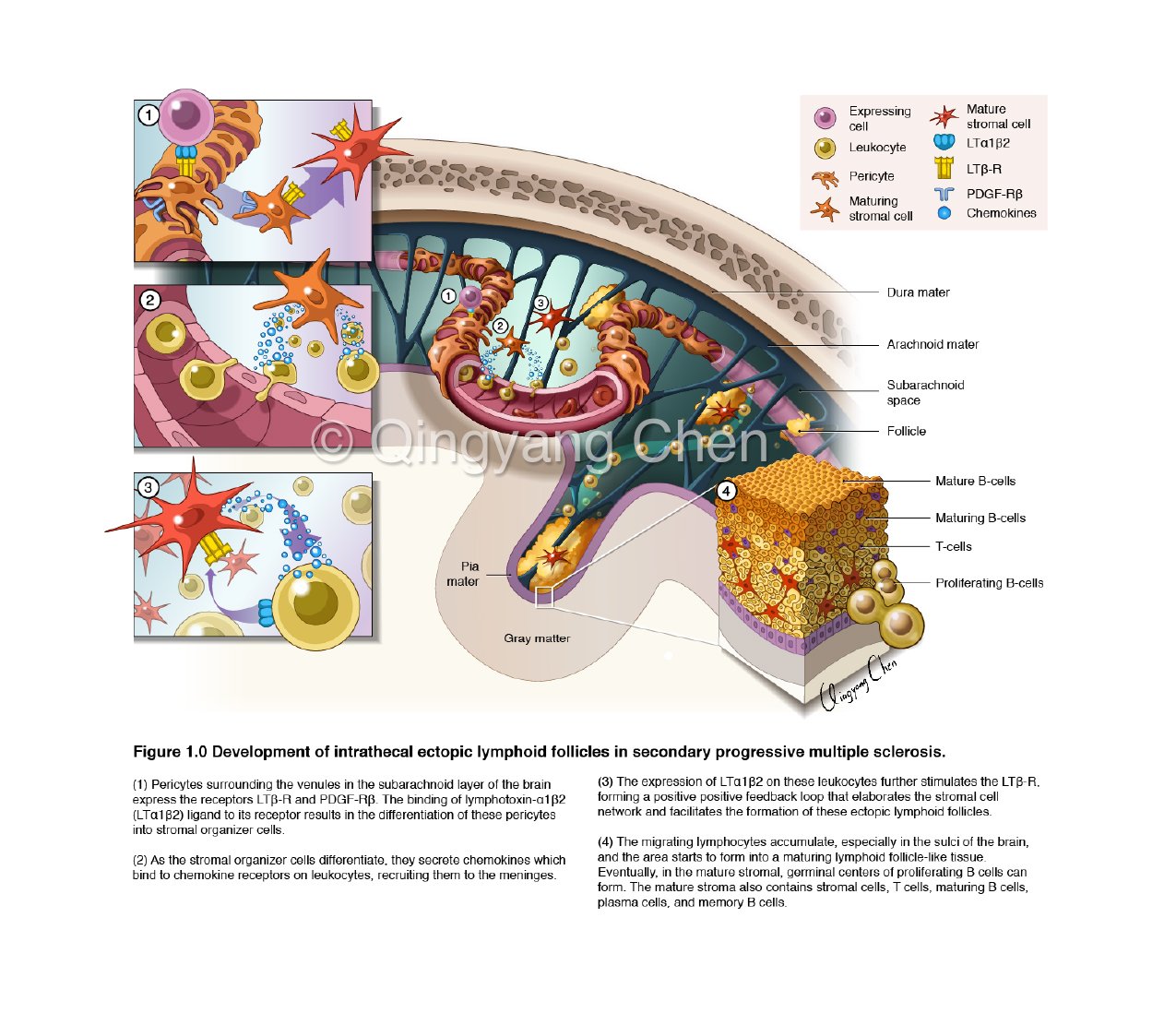 Diagram of intrathecal ectopic lymphoid follicles development in secondary progressive multiple sclerosis, showing stages of immune cell differentiation, chemokine secretion, and follicle formation in the brain and meninges.