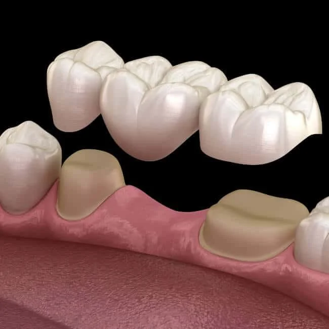 Model showing a dental bridge being placed over missing teeth in a mouth