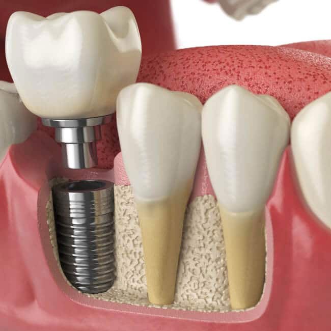 Model of a dental implant, showing the implant tooth screwing into its base in the gum