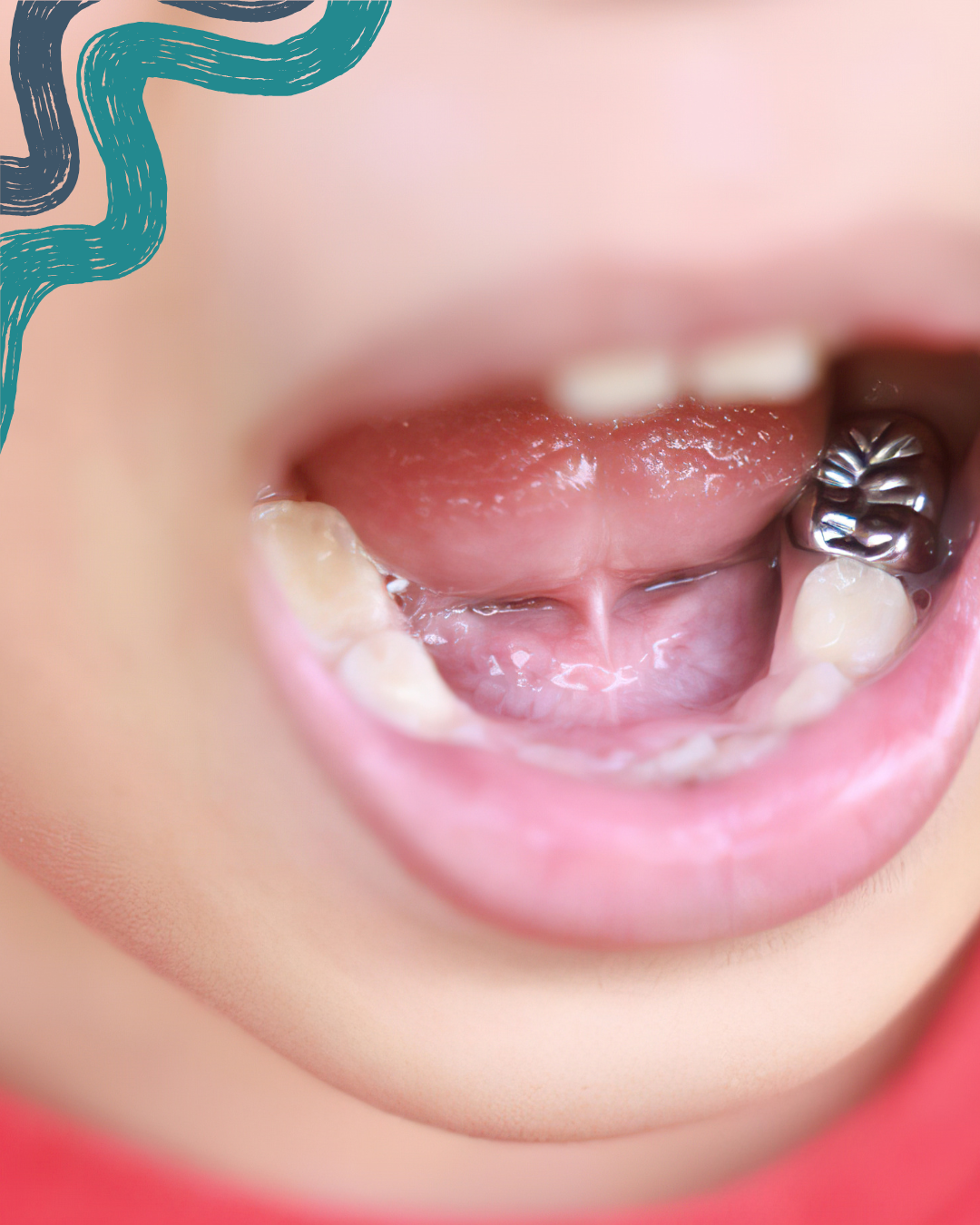 Close-up of a child's open mouth showing teeth, tongue, and a dental filling on one molar.