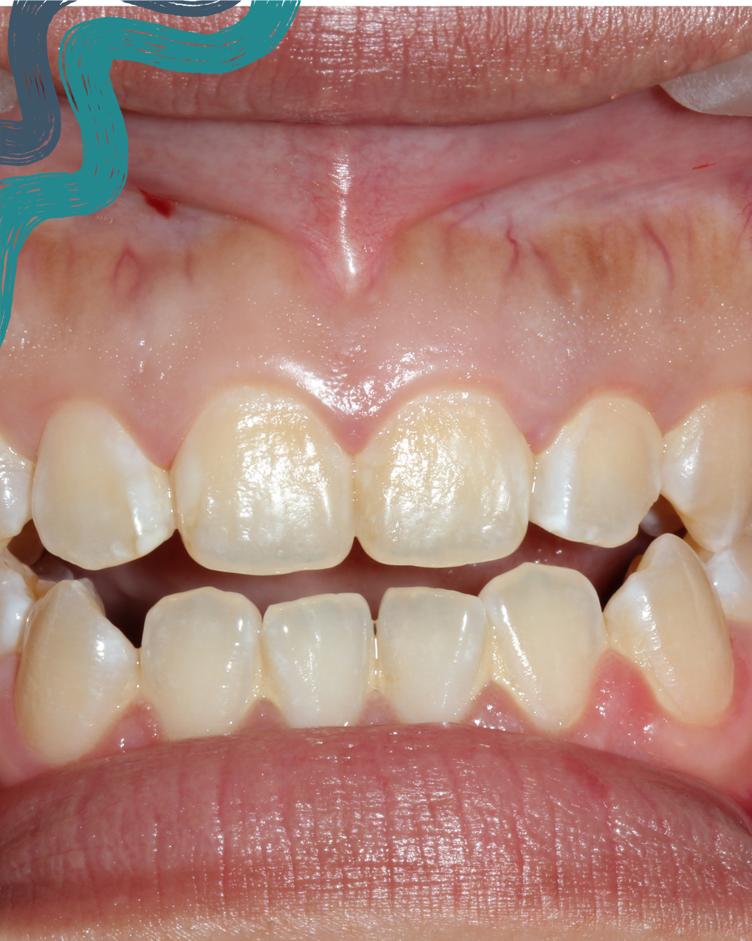 Close-up photo of a person's upper and lower front teeth and gums, showing some teeth misalignment and slight discoloration.