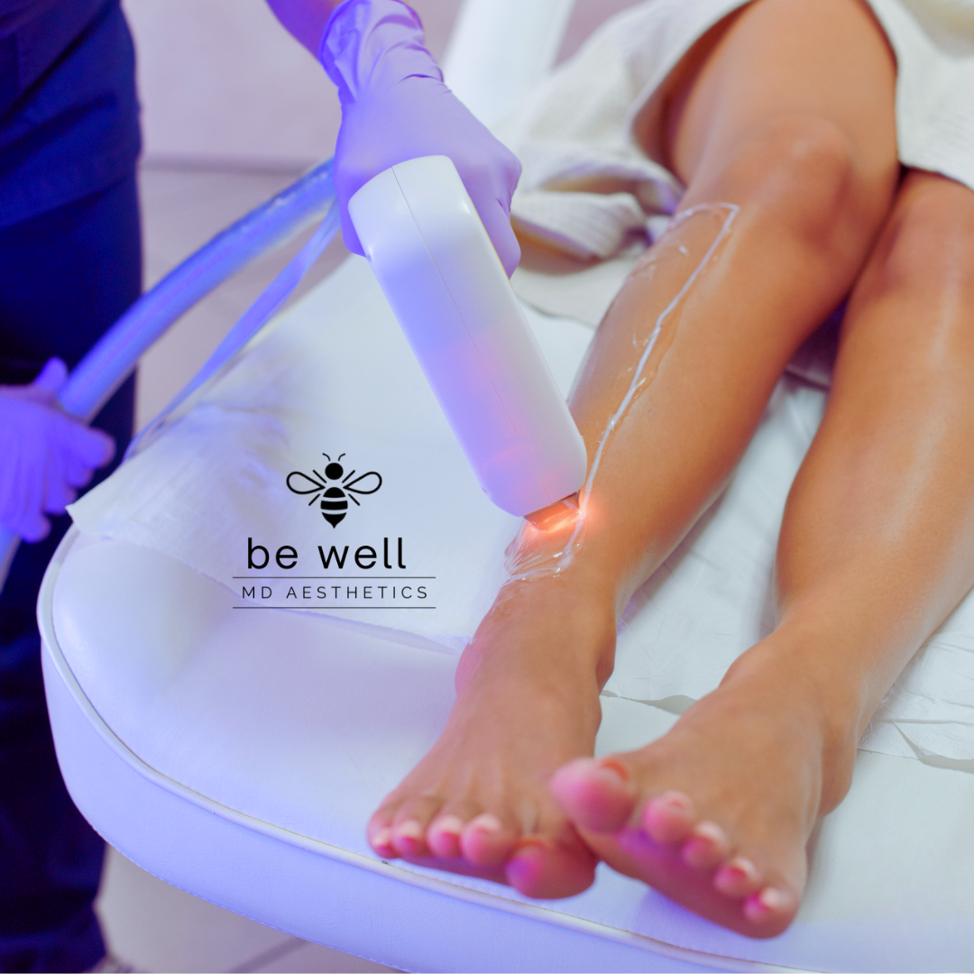 A medical aesthetic procedure being performed on a patient's lower leg using a laser device in a clinical setting.