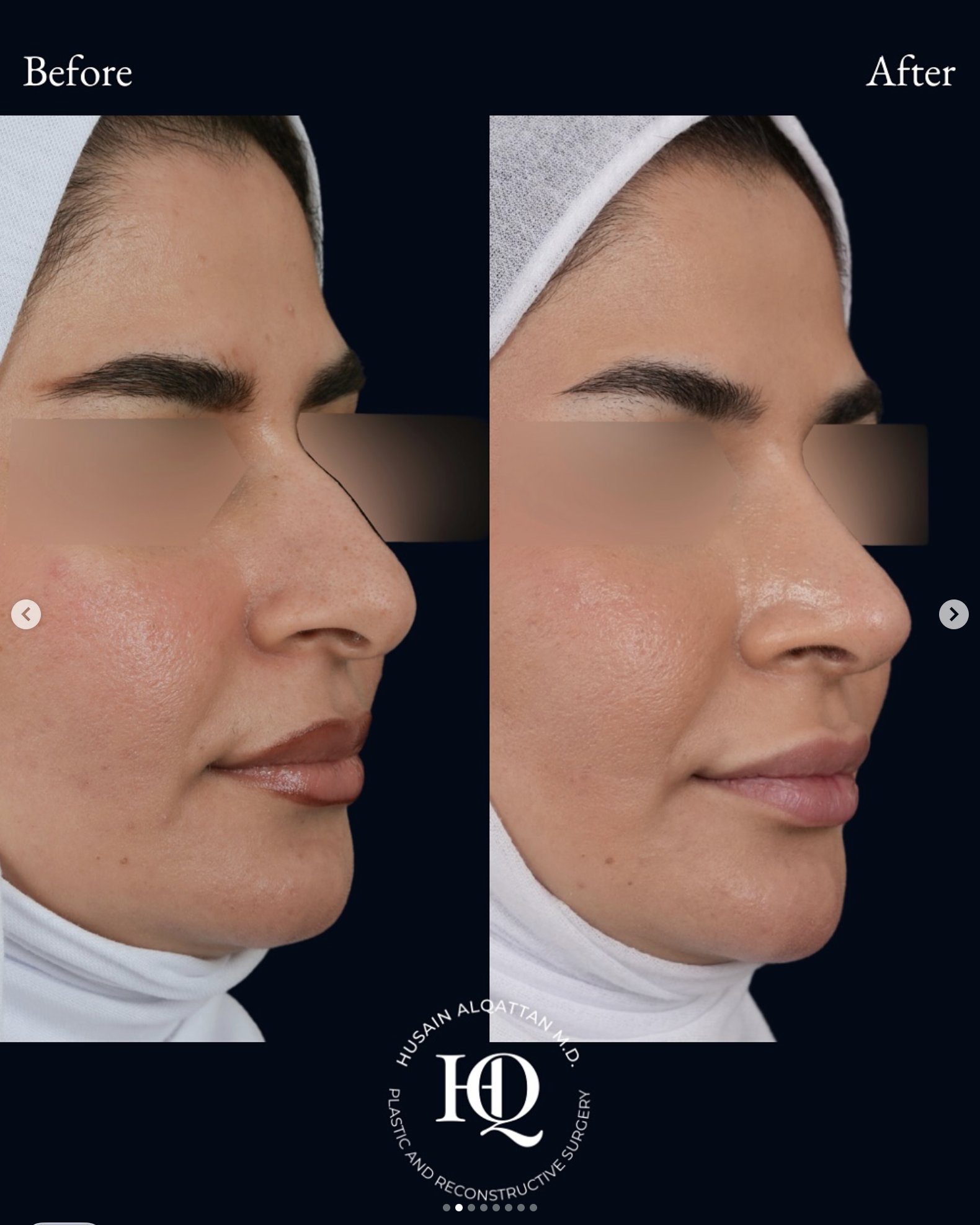 Side-by-side comparison of a woman's face before and after a cosmetic procedure, showing improved skin texture and cheek contouring.